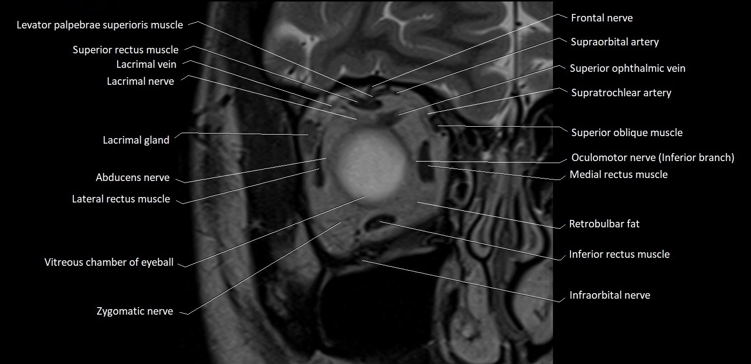 MRI Orbit coronal cross sectional anatomy image 7.webp